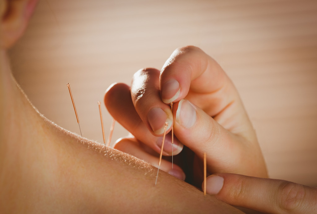 Acupuncture