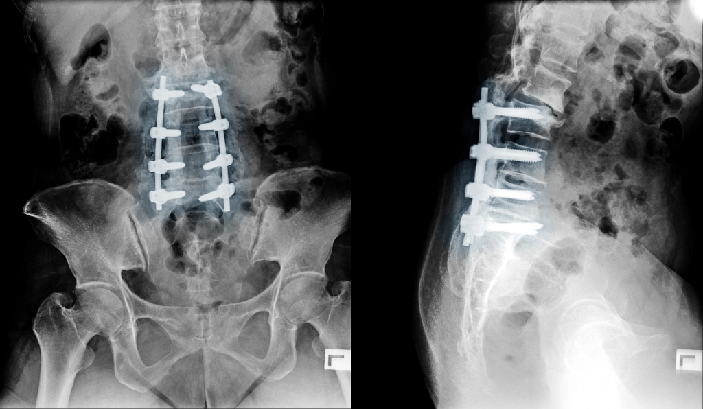 Braces installed on spine