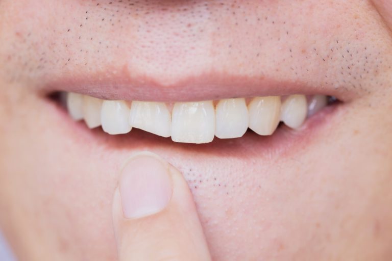 man with damaged and cracked tooth in front teeth