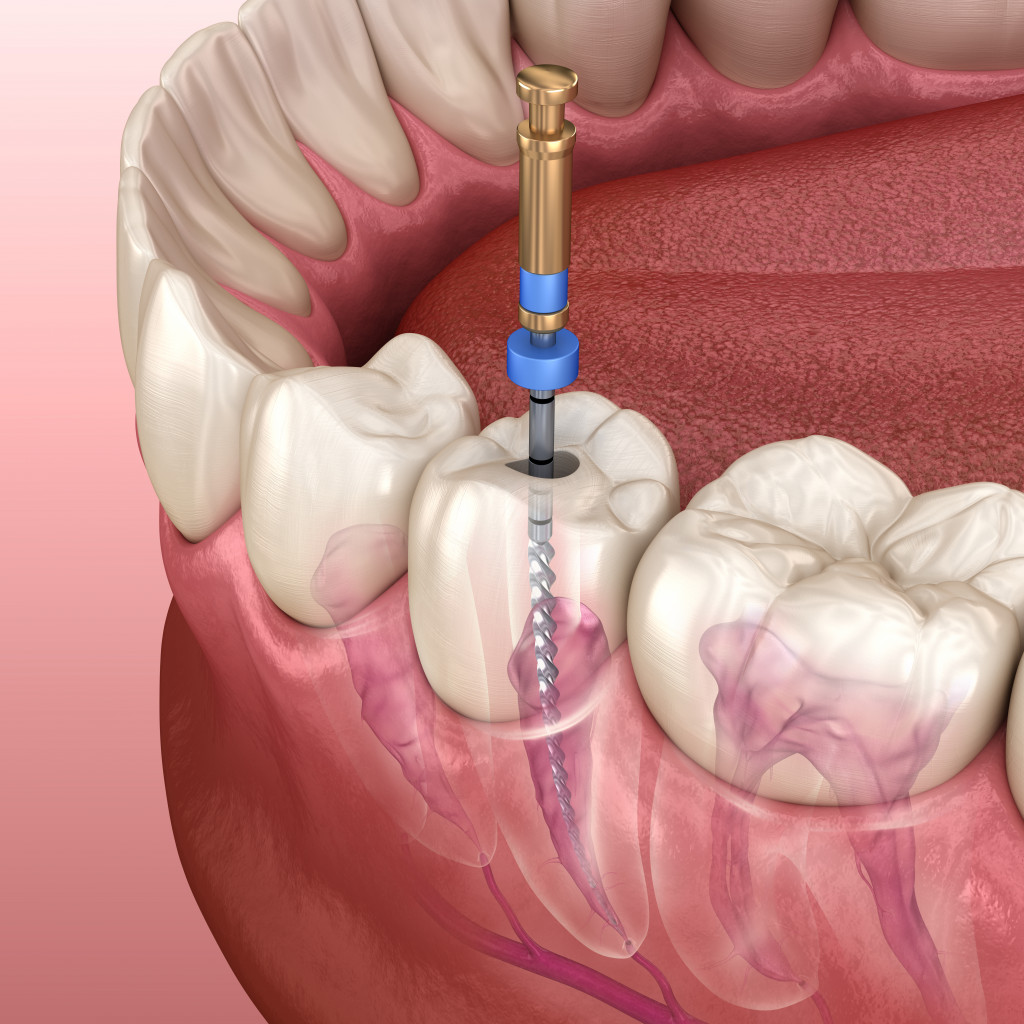 endodontic root canal therapy in 3D illustration